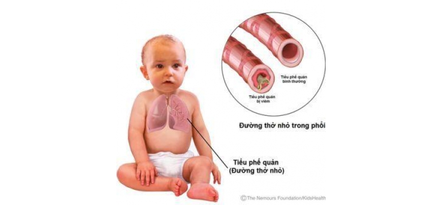 Bronchiolitis - Hình ảnh minh họa